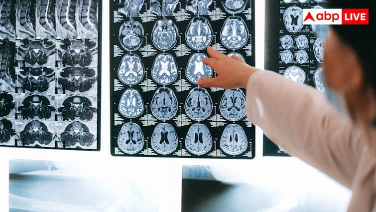 What is the Golden Period in Brain Stroke and How Long Can a Patients Life Be Saved ब्रेन स्ट्रोक के मरीजों के लिए क्या होता है गोल्डन पीरियड, कब तक बच सकती है जान?